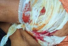 မိုးကောင်းတွင် ယမန်နေ့ညက လက်မောင်းကျည်ထိမှန်ခဲ့သည့် အမျိုးသမီးအား မြစ်ကြီးနားစစ်ဆေးရုံသို့ ပို့ဆောင်